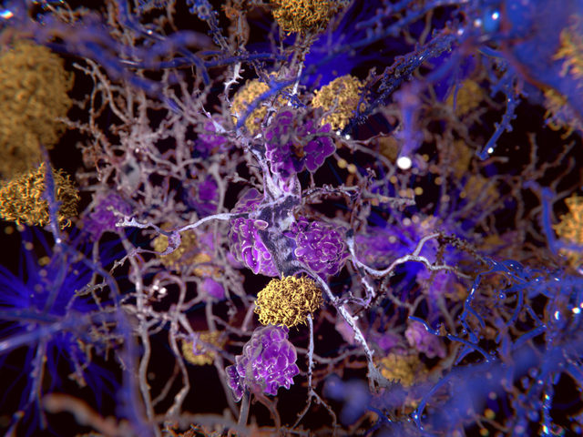 New Dimensions of Alzheimer’s In A Dish